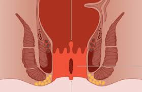 Therapeutic Evaluation of Compound Unani Formulation for Chronic Fissure-In-Ano: A Case Series
