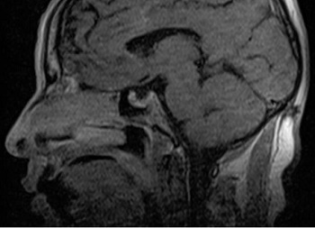 Recurrent Hyperprolactinemia and Neuro-Endocrine Decompensation Following Self-Discontinuation of Ca...